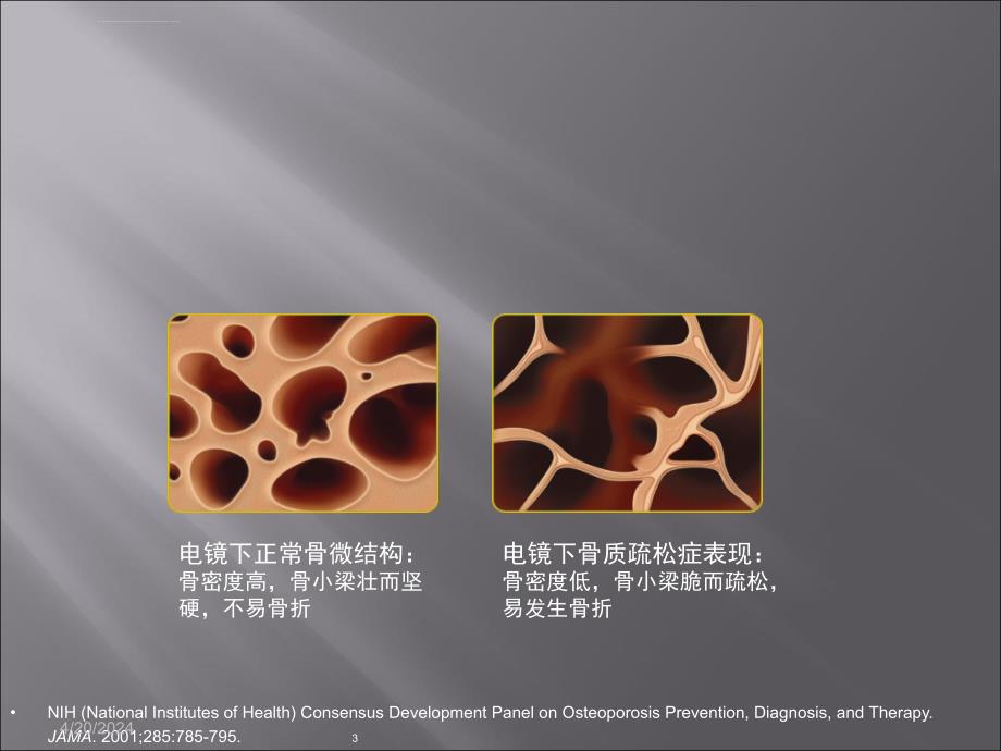 copd合并骨质疏松症ppt课件_第3页