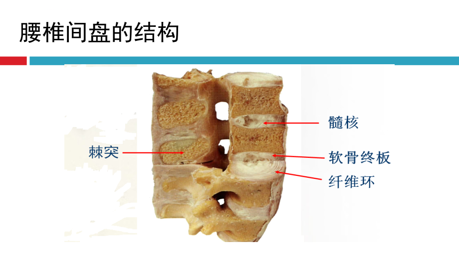 腰椎间盘突出症2017ppt课件_第4页