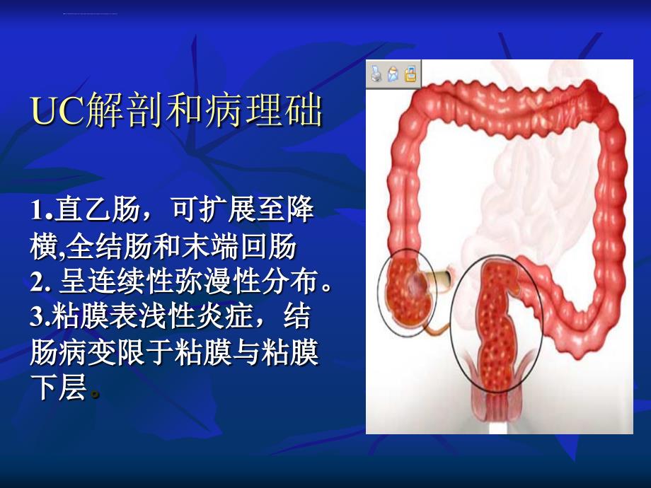 溃疡性结肠炎定义、临床表现和治疗ppt课件_第3页