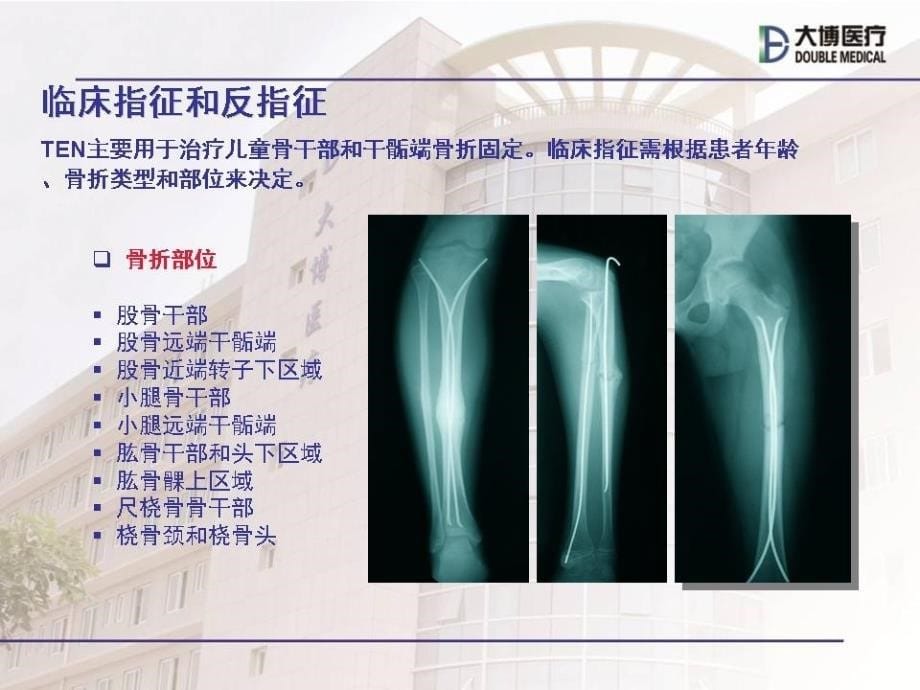 弹性髓内钉治疗儿童骨折操作技巧ppt课件_第5页