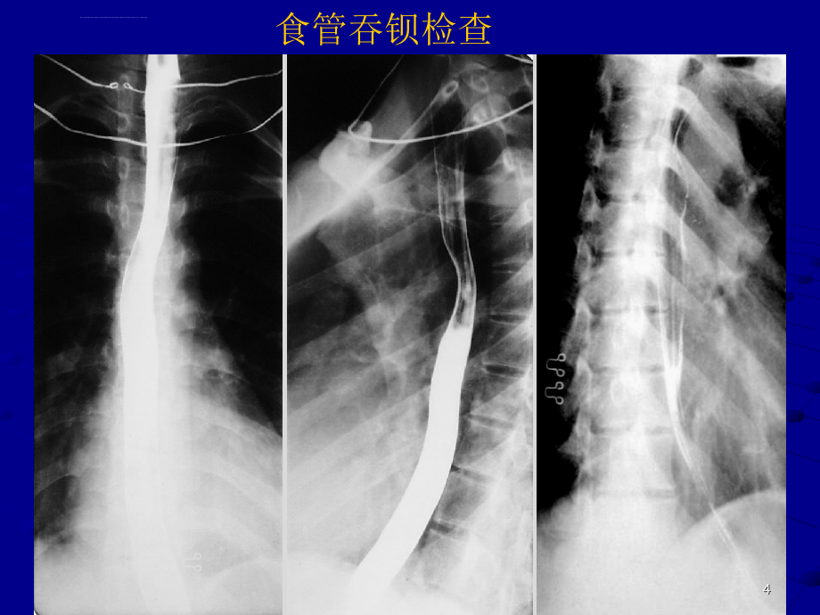 上消化道出血讲课用ppt课件_第4页