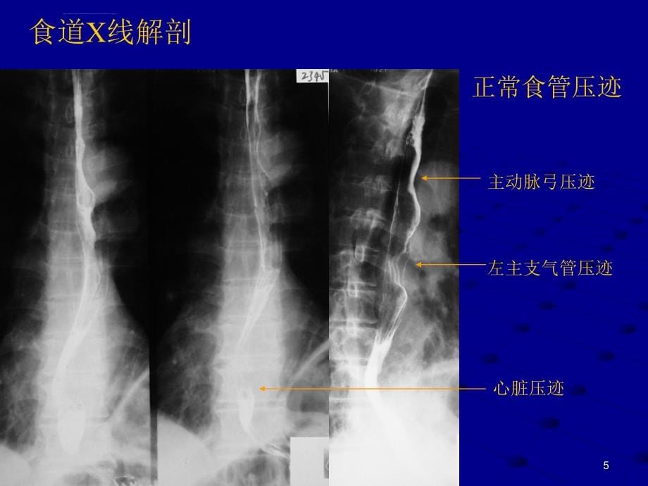 上消化道出血讲课用ppt课件_第5页