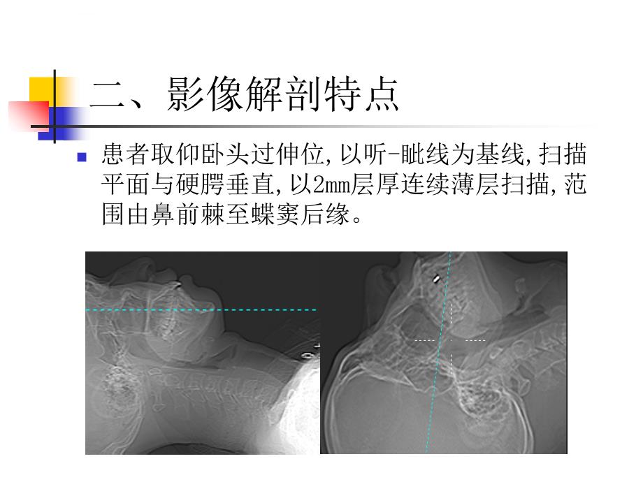 窦口-鼻道复合体影像解剖及临床意义ppt课件_第4页