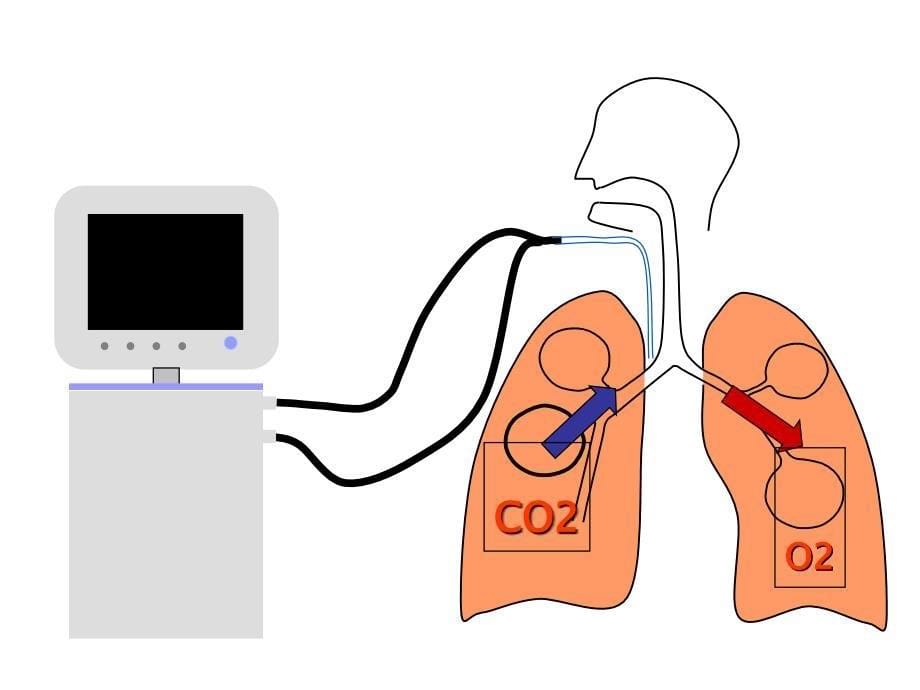 呼吸机的使用及气道管理ppt课件_第5页