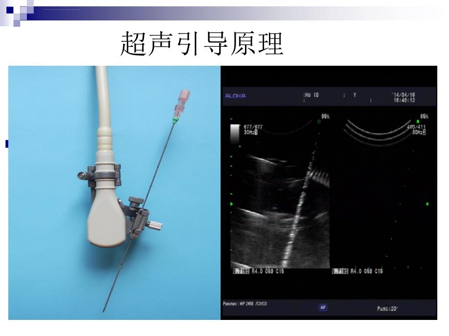 甲状腺疾病针吸细胞学诊断ppt课件_第2页