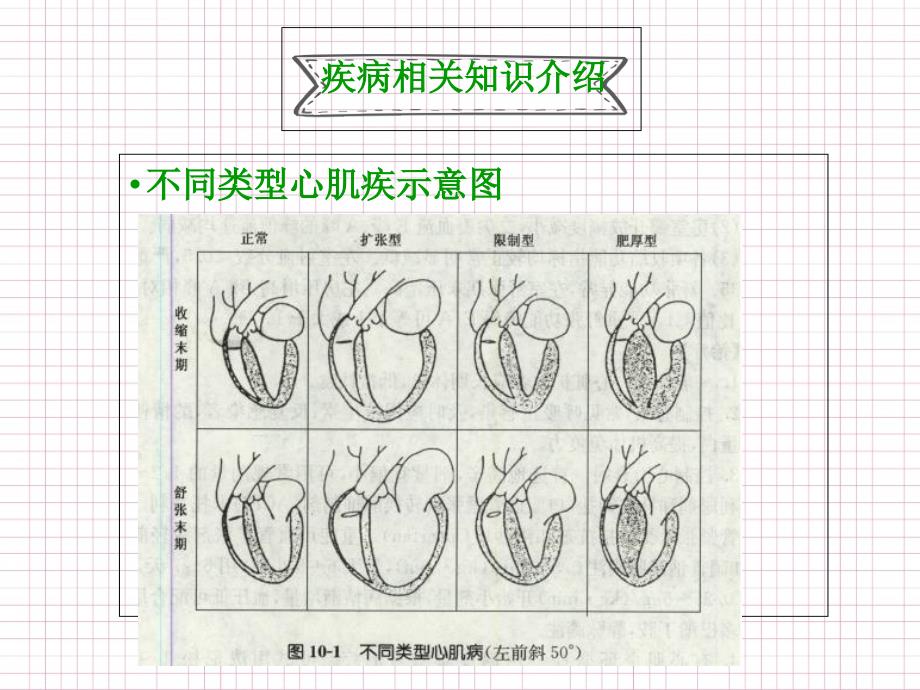 扩张型心肌病的护理ppt课件_第4页