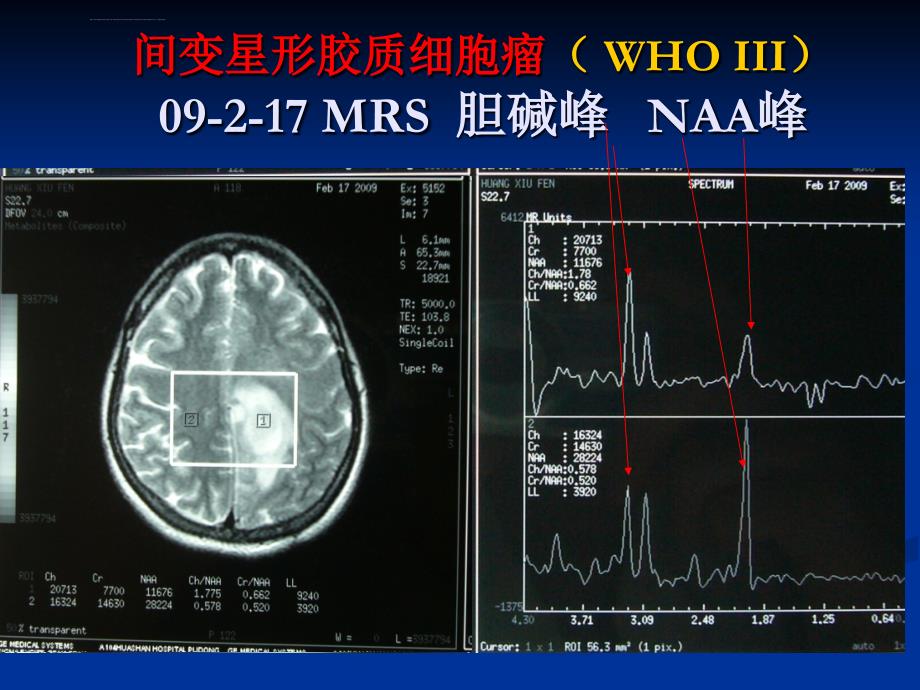 神经外科常见影像学与肿瘤简介02ppt课件_第3页