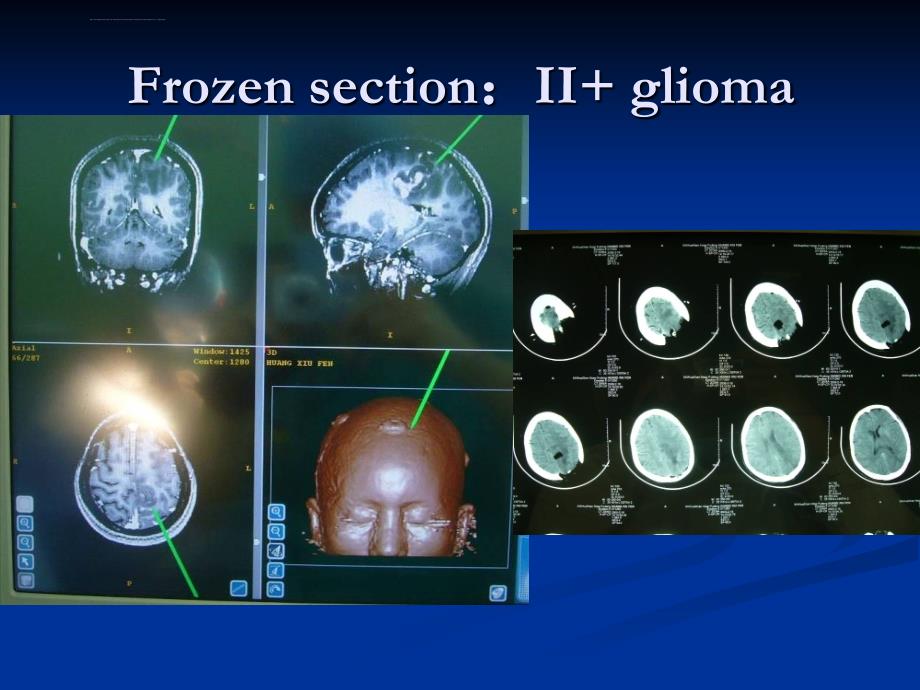 神经外科常见影像学与肿瘤简介02ppt课件_第4页