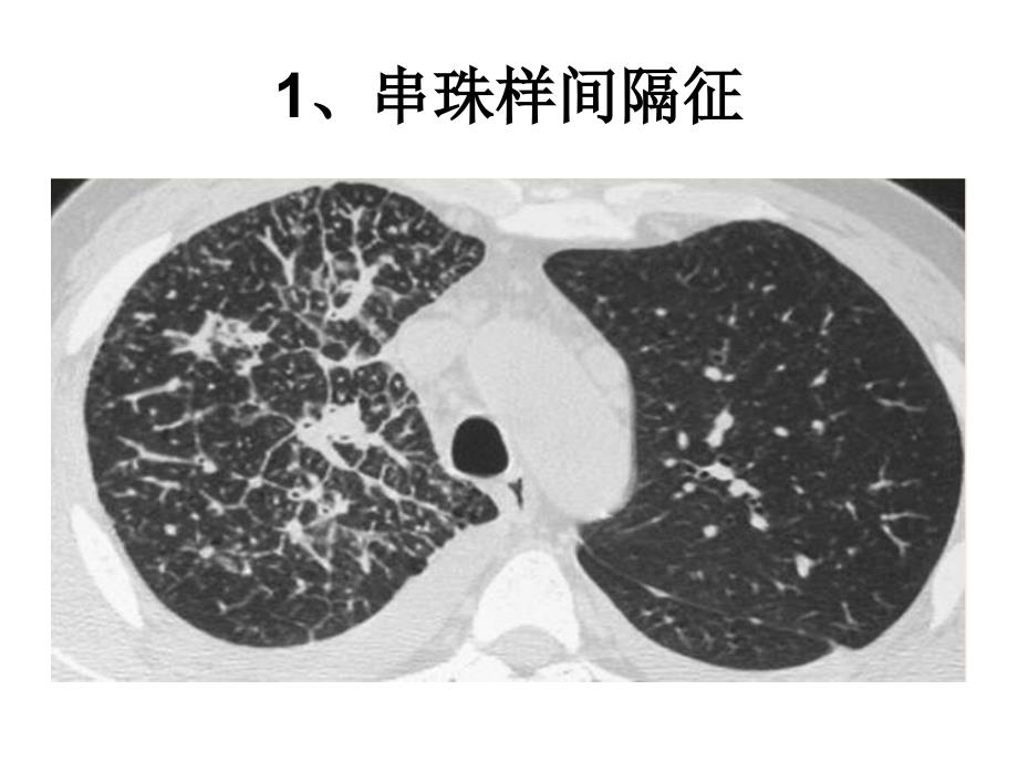 医学ppt--胸部医学影像征象总结_第2页