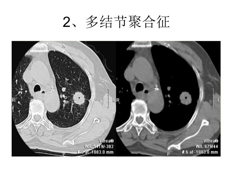 医学ppt--胸部医学影像征象总结_第4页