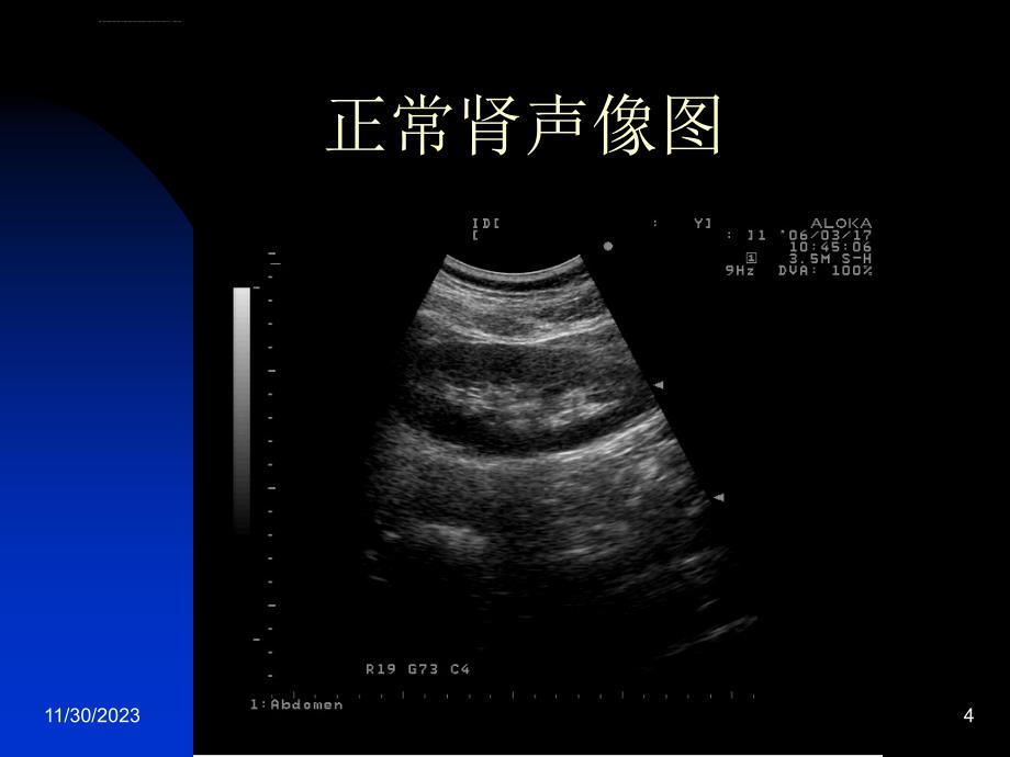 肾脏常见疾病的超声诊断ppt课件_第4页