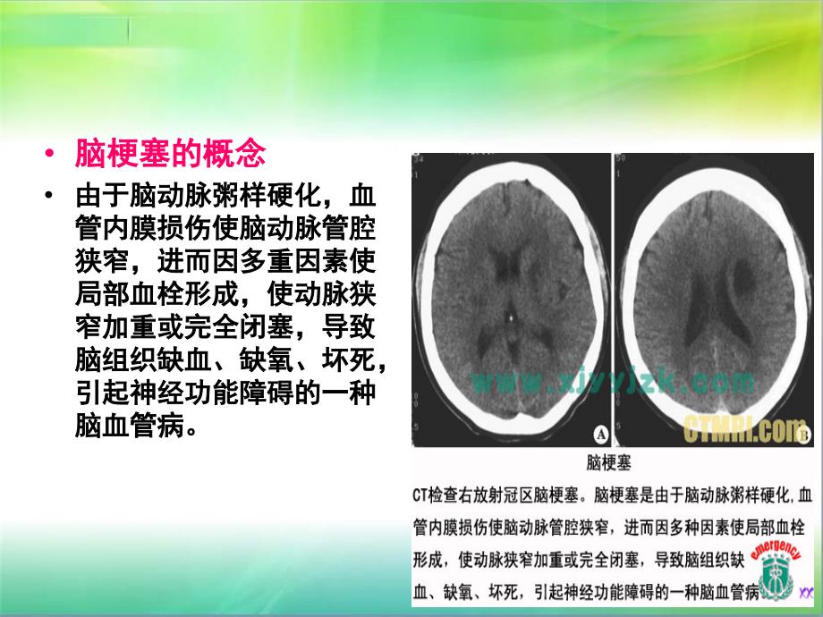 脑梗塞患者护理教学查房ppt课件_第4页