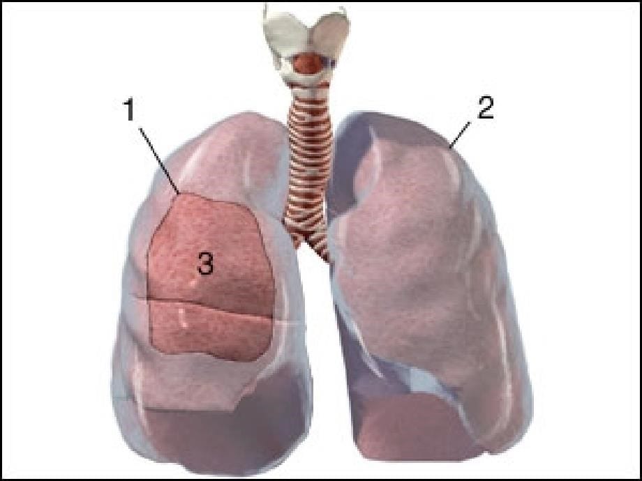 胸膜炎和气胸ppt课件_第5页