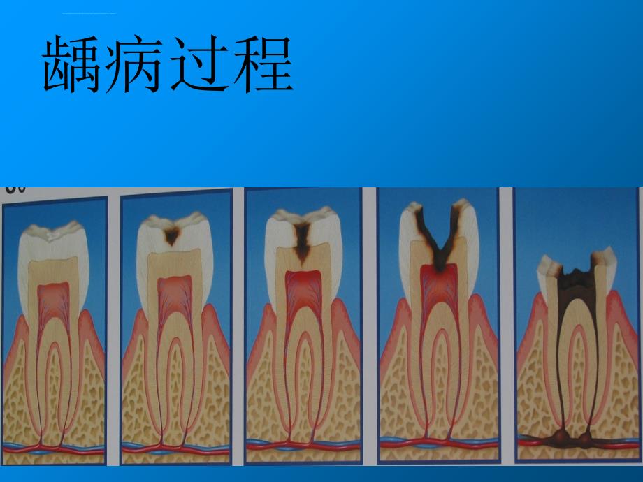 口腔保健培训讲课ppt课件_第4页