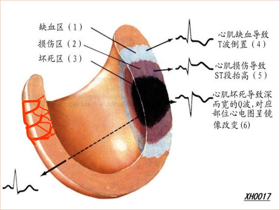 心肌梗死心普大_第3页