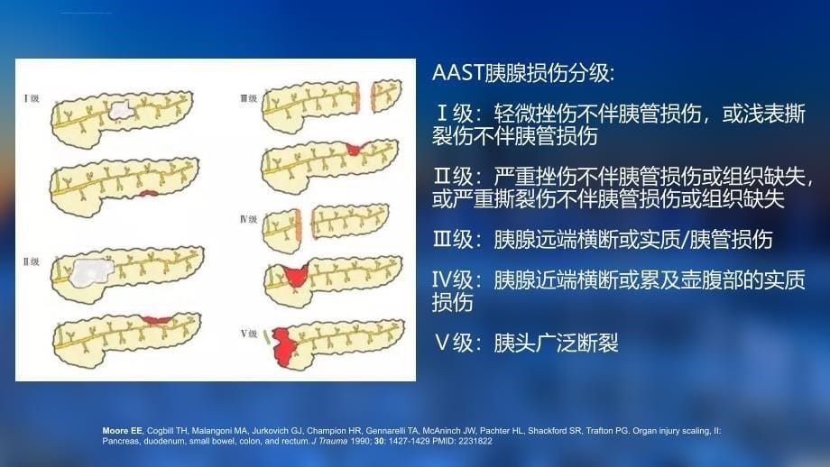 胰腺外伤诊治ppt课件_第5页