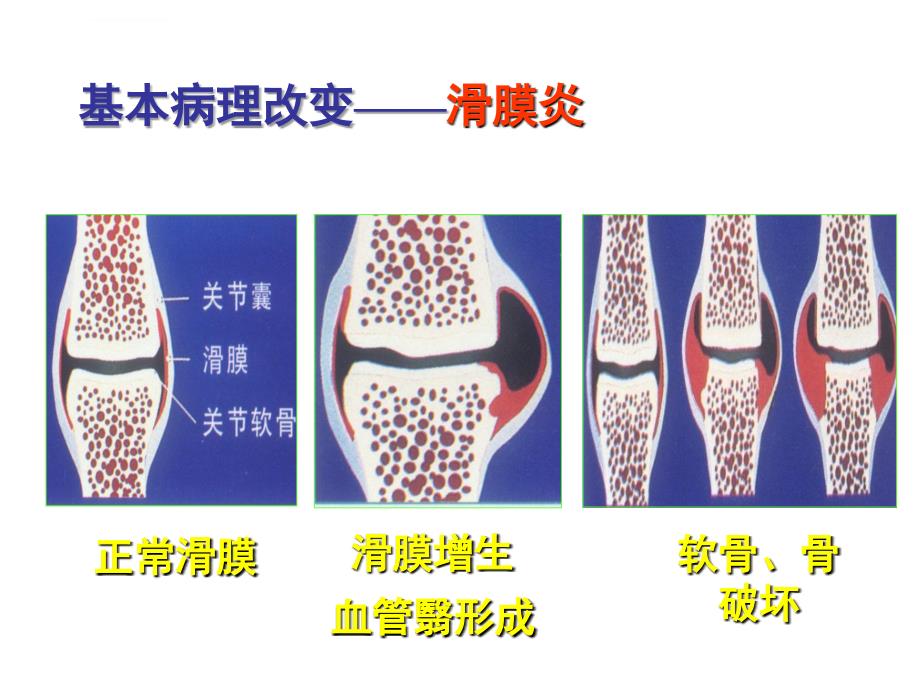 类风湿性关节炎ppt课件_第5页