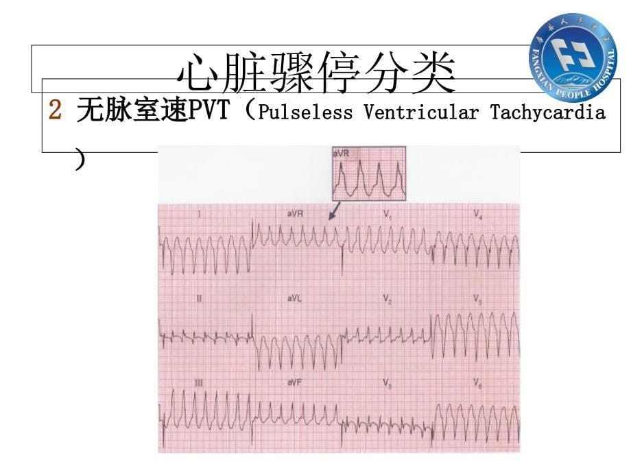 胸痛中心复苏cprppt课件_第5页