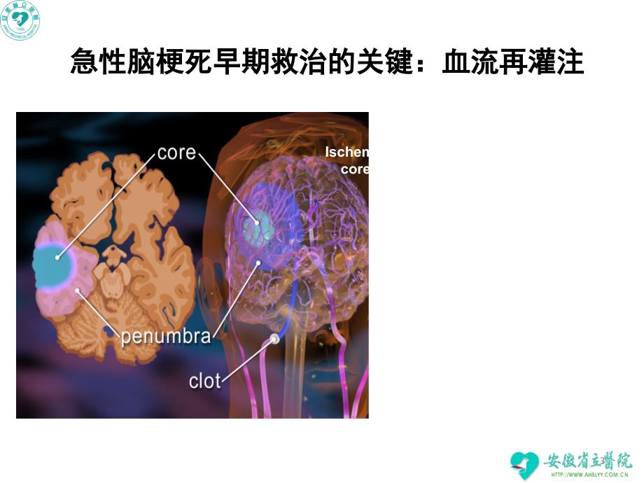 急性脑梗死静脉溶栓指南解读培训——神经内科王国平ppt课件_第3页