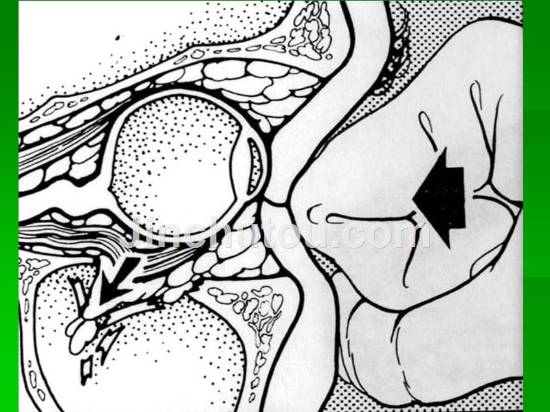 眼科眼眶爆裂性骨折ppt课件_第4页