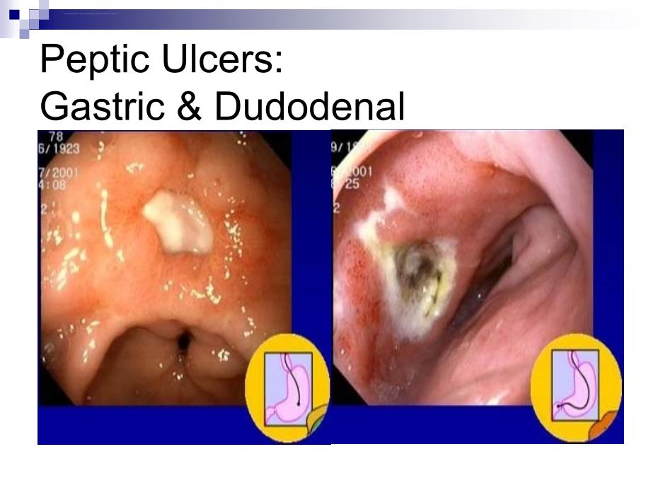 消化性溃疡英文修改版ppt课件_第4页