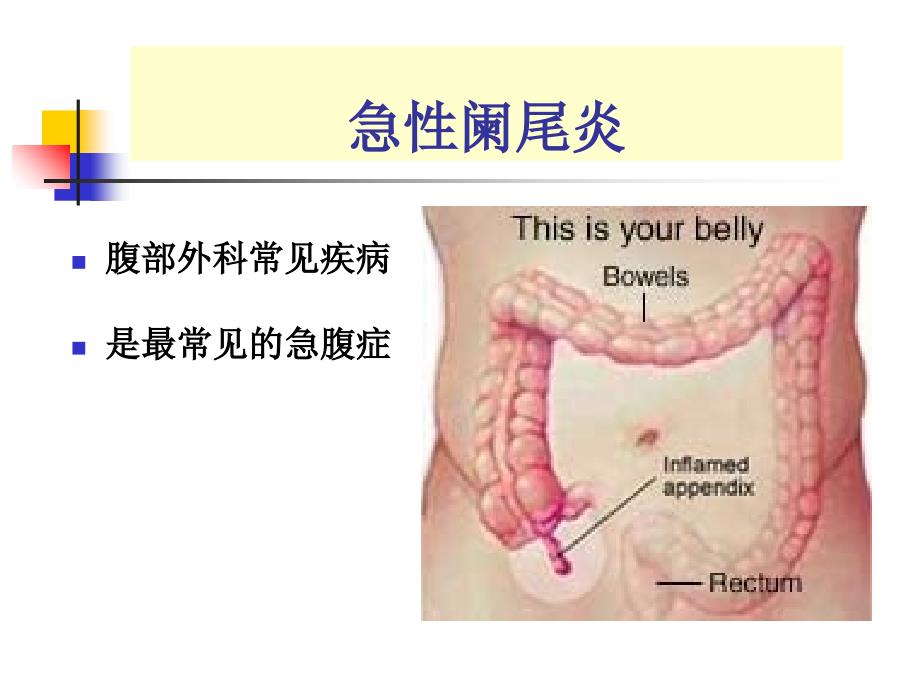 本科精品急性阑尾炎ppt课件_第2页