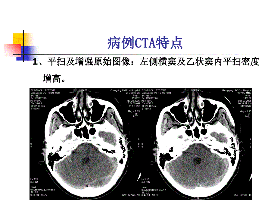 颅内静脉血栓ppt课件_第2页