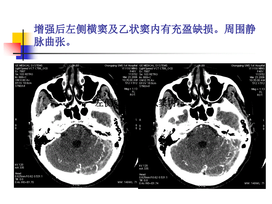 颅内静脉血栓ppt课件_第3页