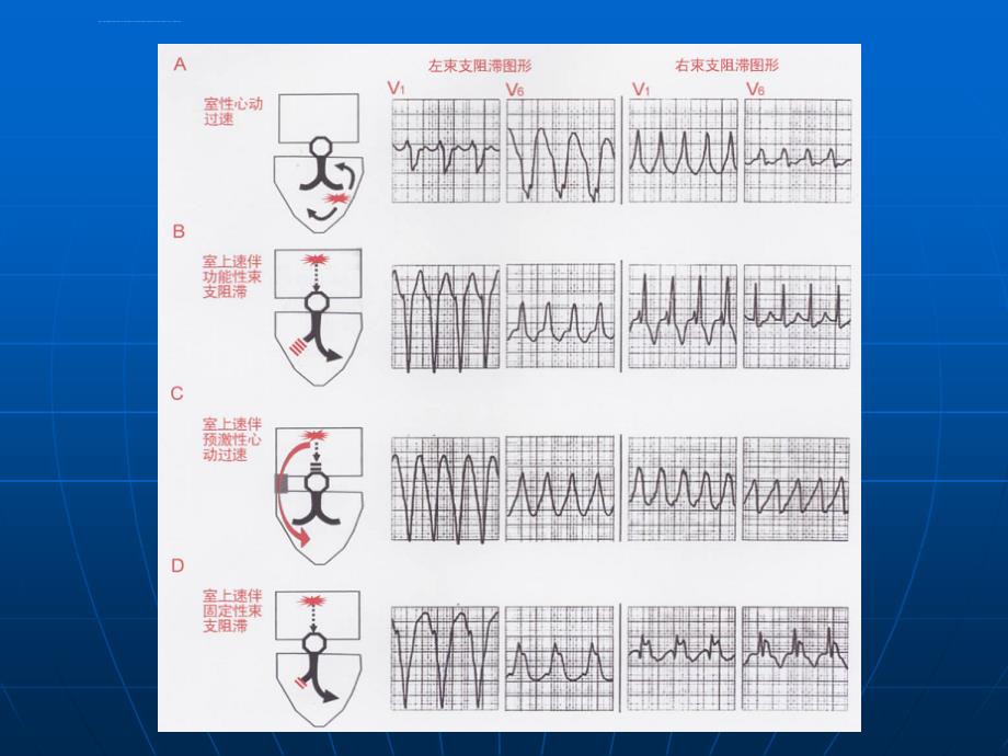 宽qrs波心动过速鉴别ppt课件_第3页
