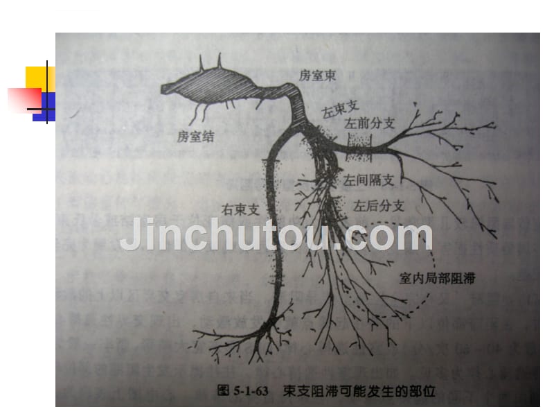 常见心律失常的心电图表现与解读ppt课件_第3页