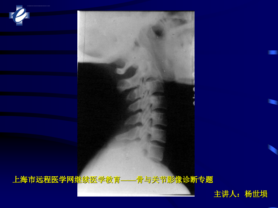 脊柱损伤的影像诊断ppt课件_第4页