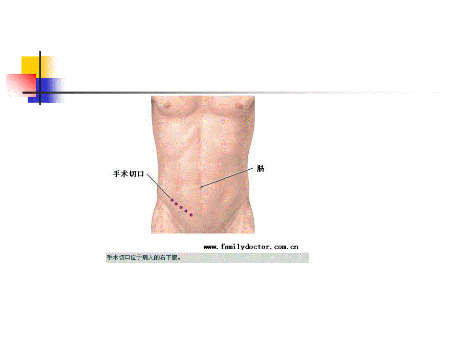 阑尾炎病人的护理ppt课件_第3页