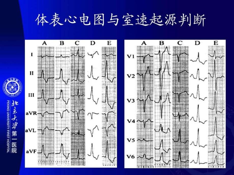 丁燕生室速起源定位ppt培训课件_第4页