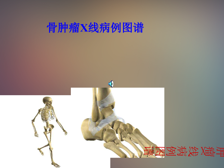 骨肿瘤x线病历图谱1ppt课件_第1页