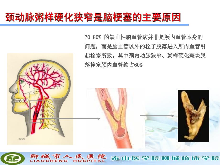 颈动脉狭窄的治疗科普讲座ppt课件_第4页