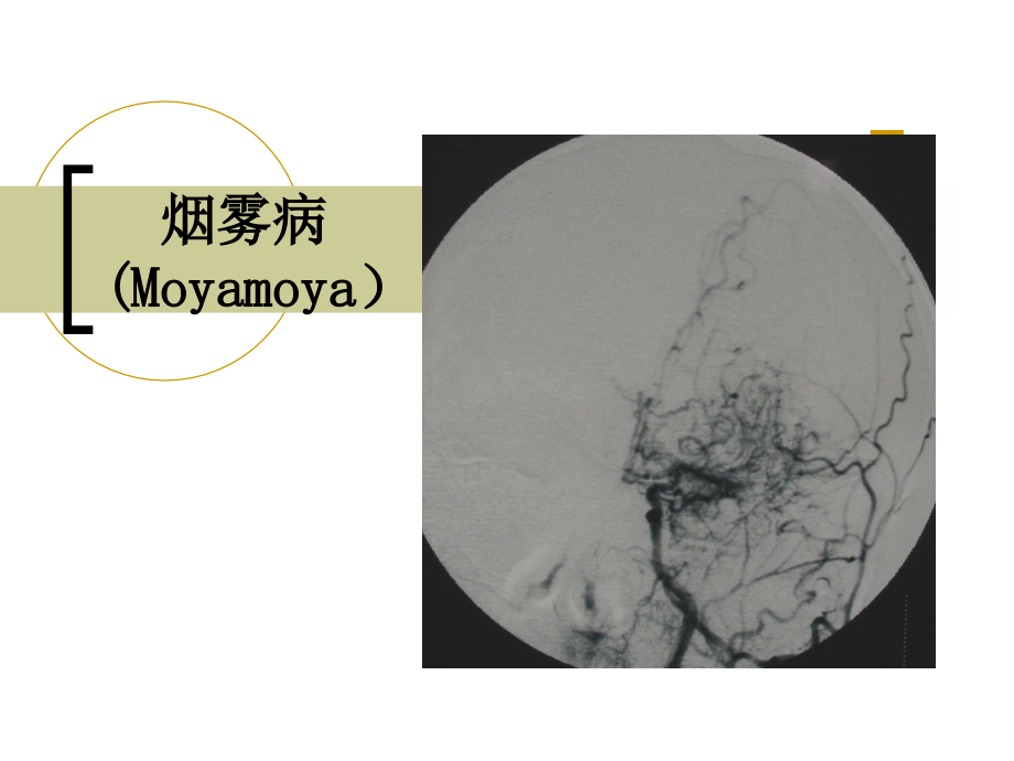 烟雾病_第1页