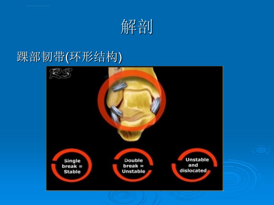 踝关节骨折laugehansen分型ppt课件_第3页