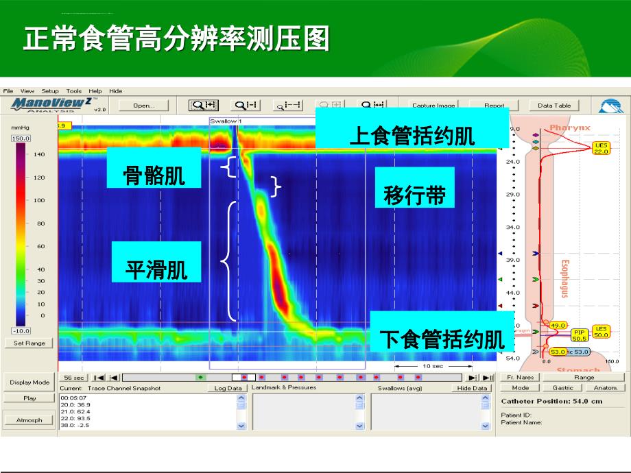 高分辨率食管测压检测技术的临床应用（精品ppt）_第4页