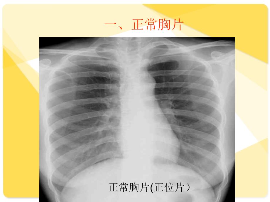 肺部疾病影像学阅片_第2页