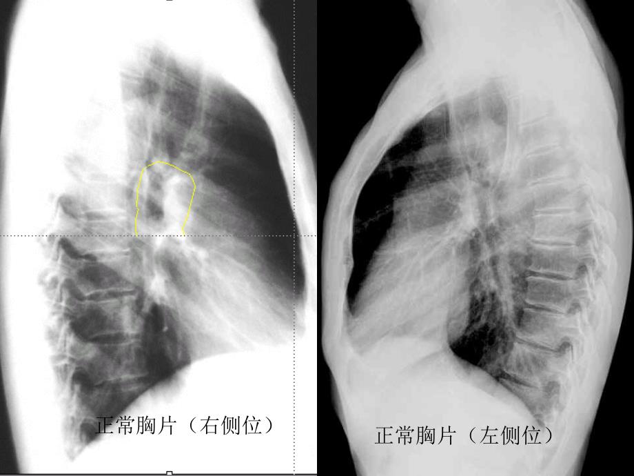 肺部疾病影像学阅片_第4页