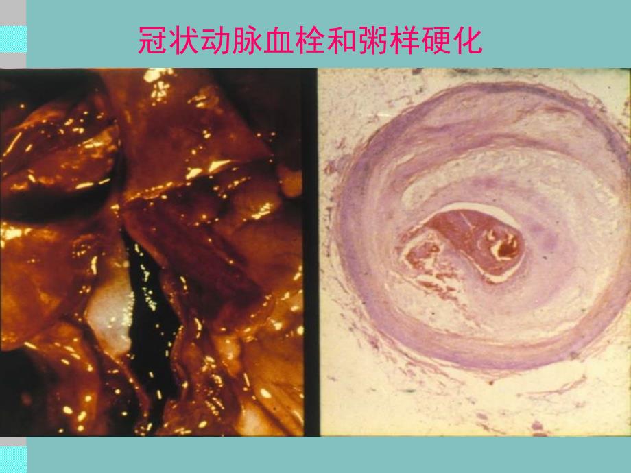 冠状动脉粥样硬化性心脏病（chd）_第3页