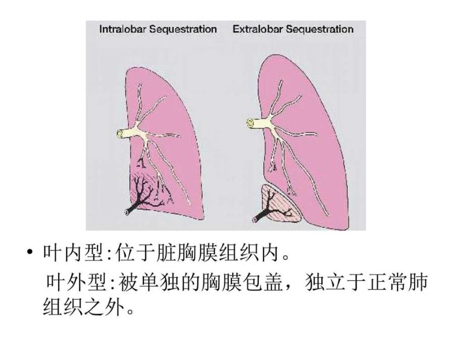 肺隔离症的麻醉ppt培训课件_第3页