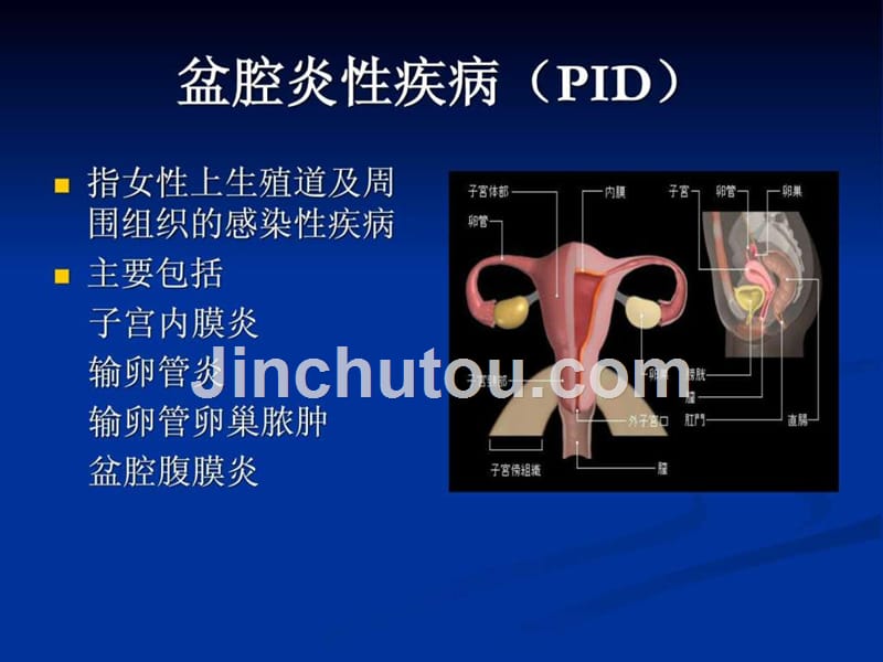 盆腔炎性疾病（培训课件）_第4页