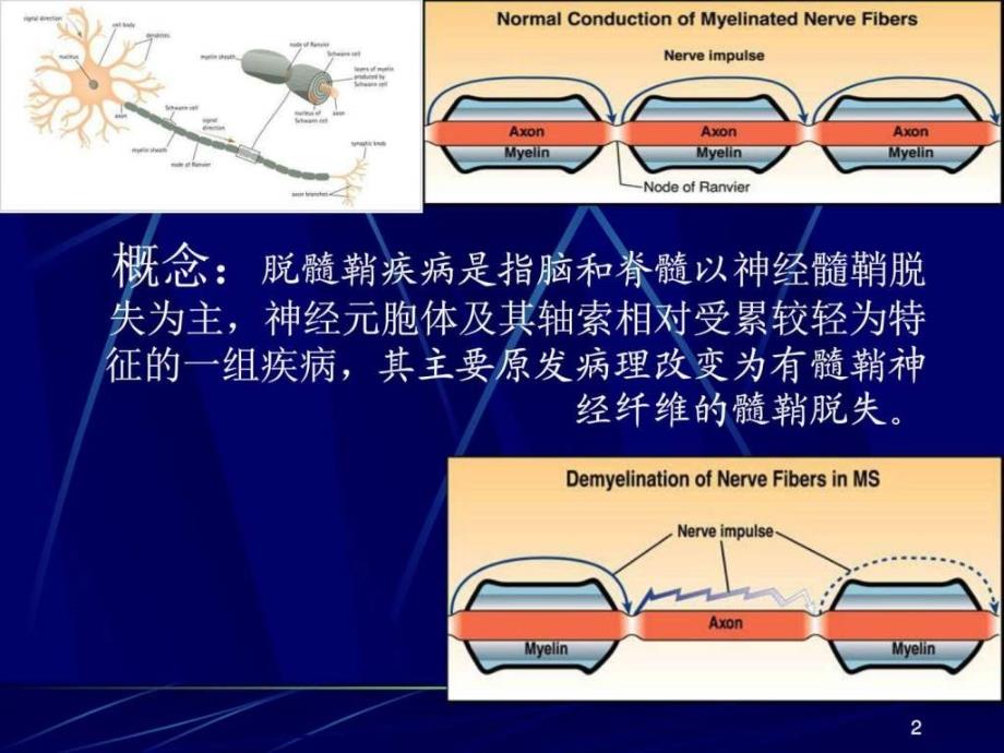 中枢神经系统脱髓鞘疾病本科ppt培训课件_第2页