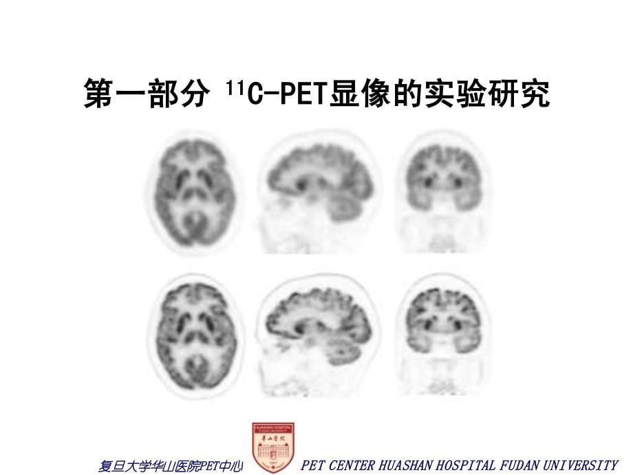 正电子发射断层(pet)基础与临床研究-脑肿瘤11c-cholinepetct显像及其在放射治疗计划中的应用[硕士答辩]_第5页