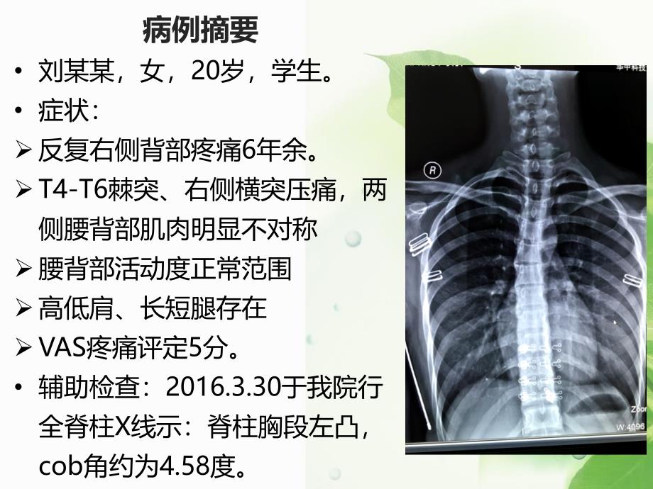 脊柱侧弯分享病例_第4页