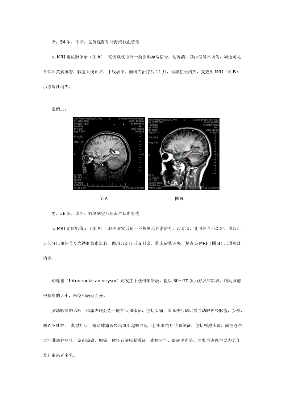 海绵状血管瘤与小动脉瘤的伽玛刀治疗_第2页