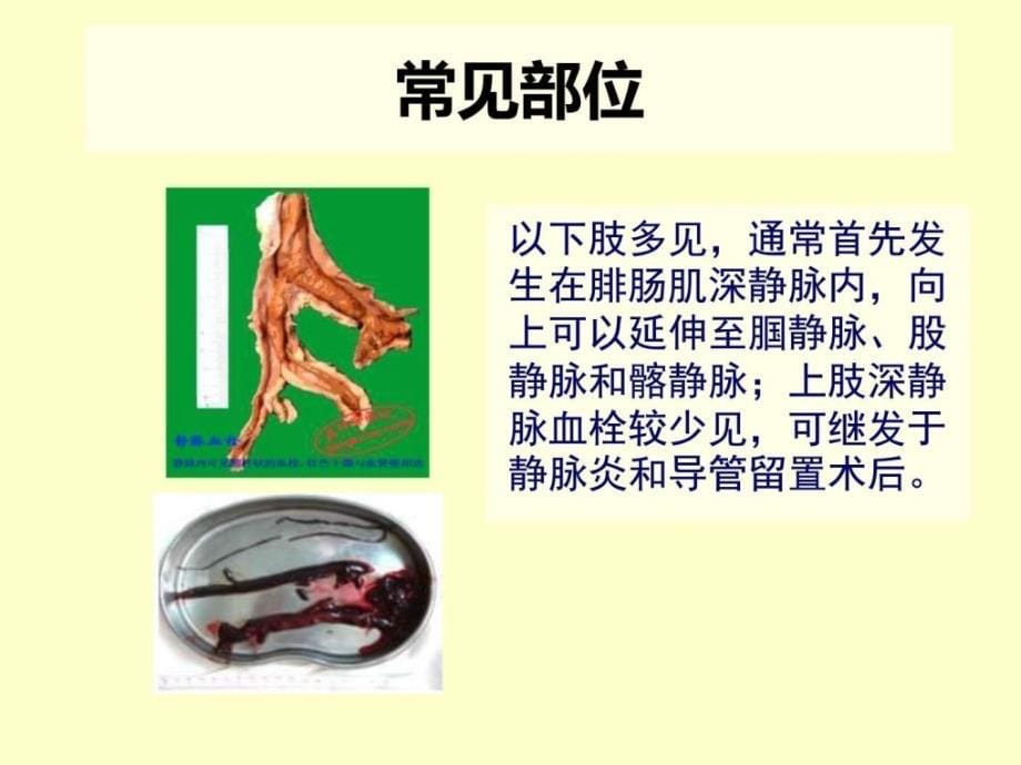 深静脉血栓的预防及护理ppt培训课件_第5页