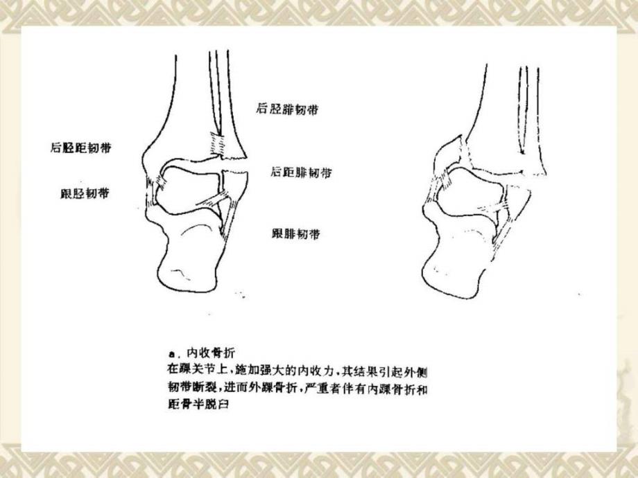 内踝骨折临床医学医药卫生专业资料课件_第3页