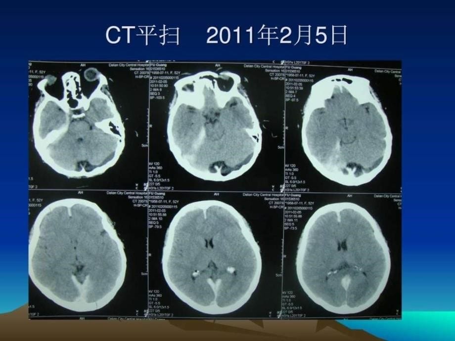 肥厚性硬脑膜炎课件_第5页